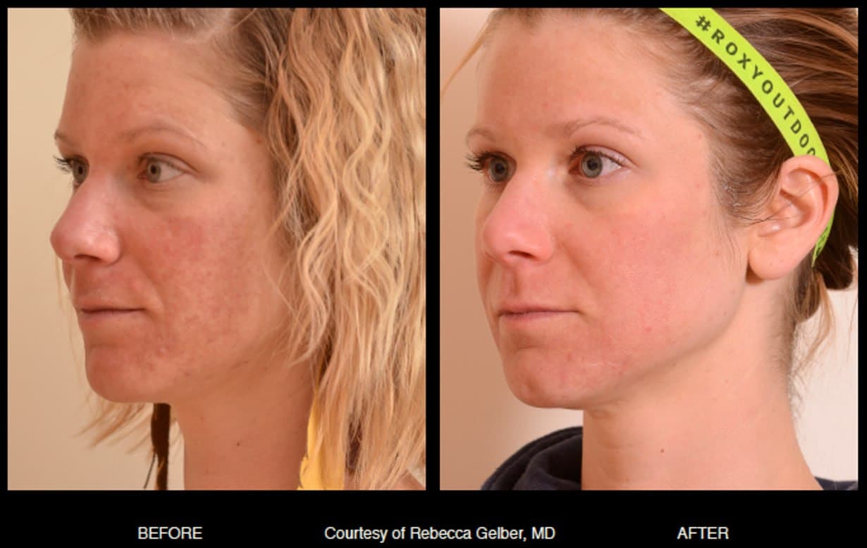 Before and after result